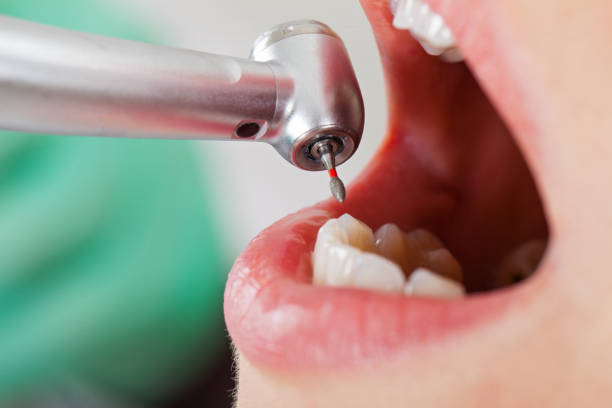 Best Emergency Dental Care for Broken or Chipped Teeth in Greer, SC